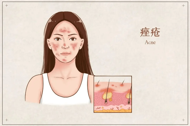 港版和韩版有啥区别苹果:昆明皮肤管理：痤疮和粉刺有啥区别