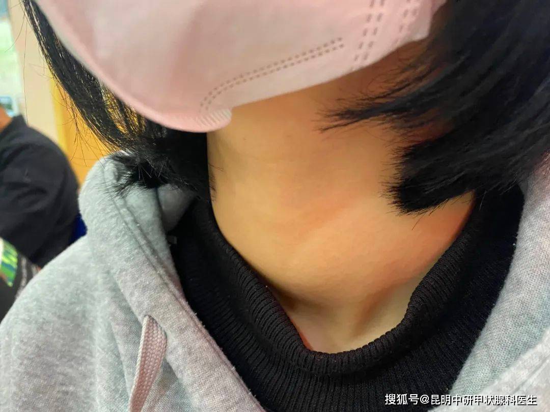 咸鱼苹果破解版
:甲状腺疾病多是吃出来的，这6种食物尽量少吃！